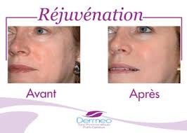 rejuvenation